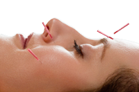 accupuncture